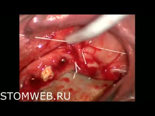 Advanced simultaneous bone ridge augmentation and internal sinus elevation part 2 of 2