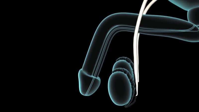 Вазэктомия мужская хирургическая контрацепция