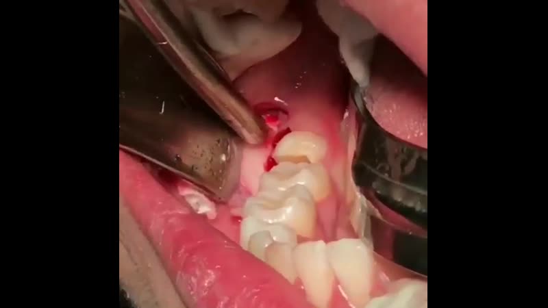 👄 удаление зуба мудрости