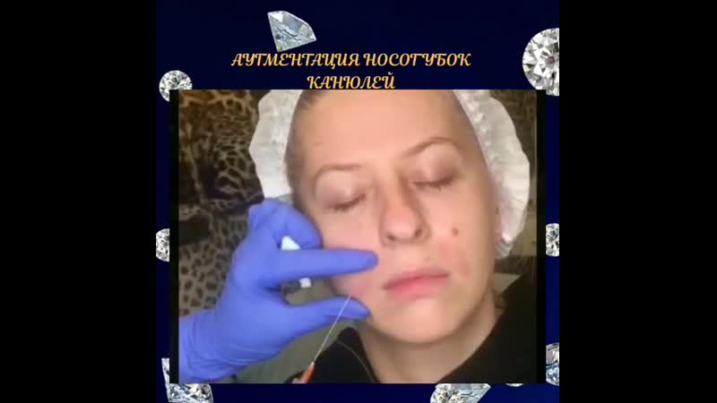 Заполнение носогубных складок канюлей