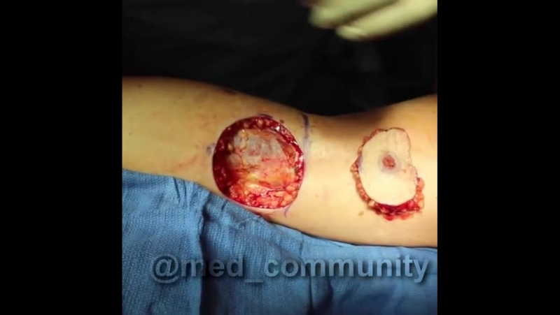 Резекция рака кожи и пластика образовавшегося дефекта