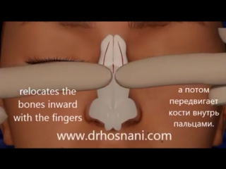 Rhinoplasty animation