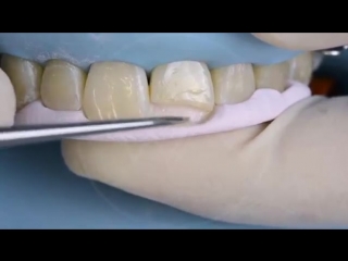 Palatal and incisal margin in class iv direct composite