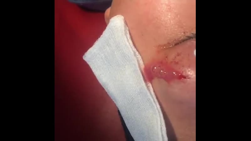 Флегмона орбиты