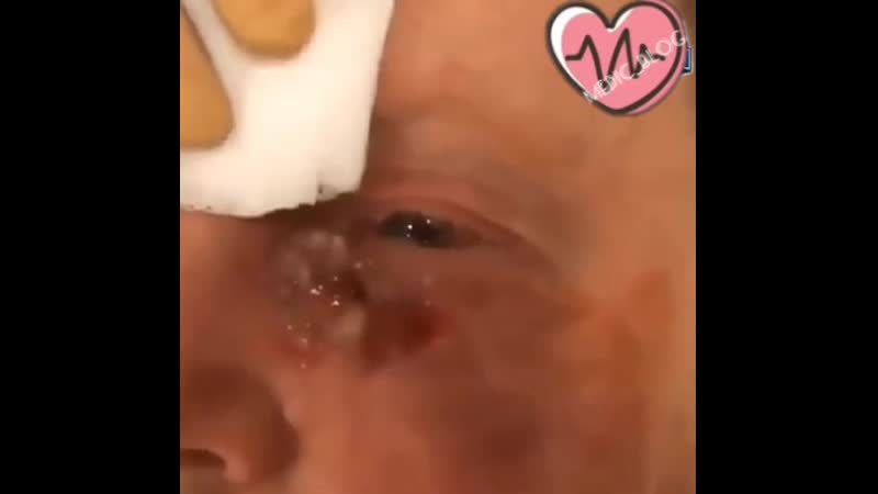 Абсцесс века