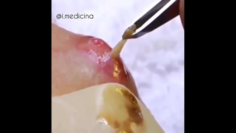 Удаление личинок овода