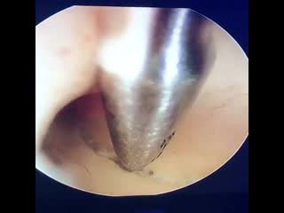 Т образная полость матки