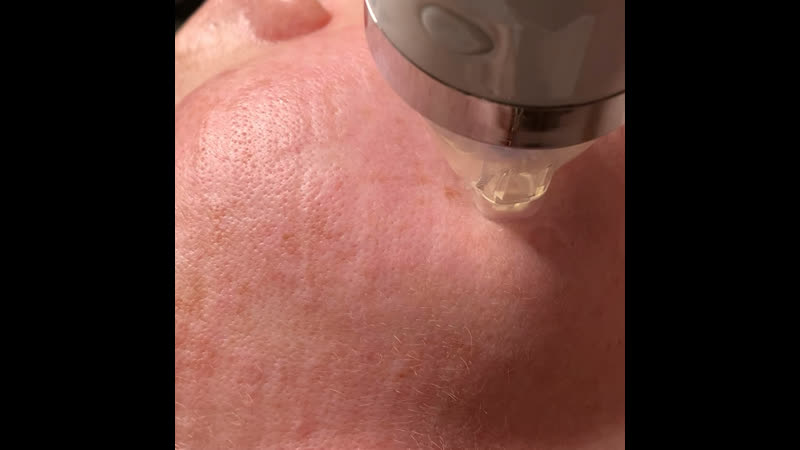 Фракционная шлифоа