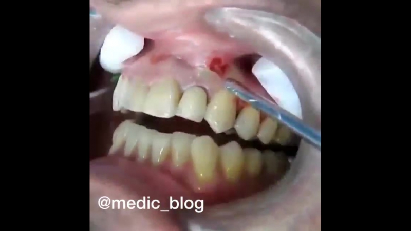 Удаление нагноения на десне