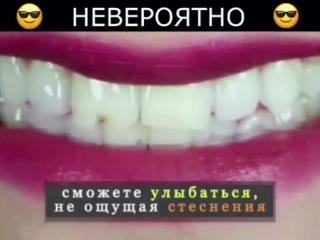 Perfect smile veneers