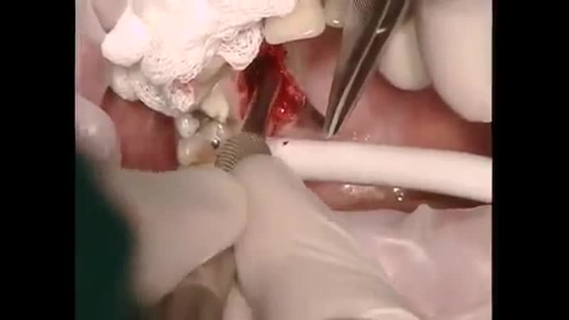 Кровотечение из большой небной артерии