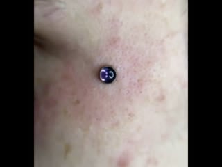 Устаноа микродермала