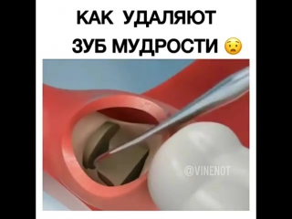 Как удаляют зуб мудрости