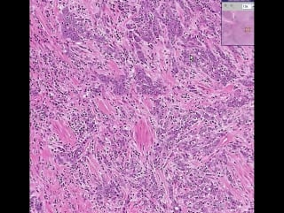 Prostate adenocarcinoma (gleason grade 5)