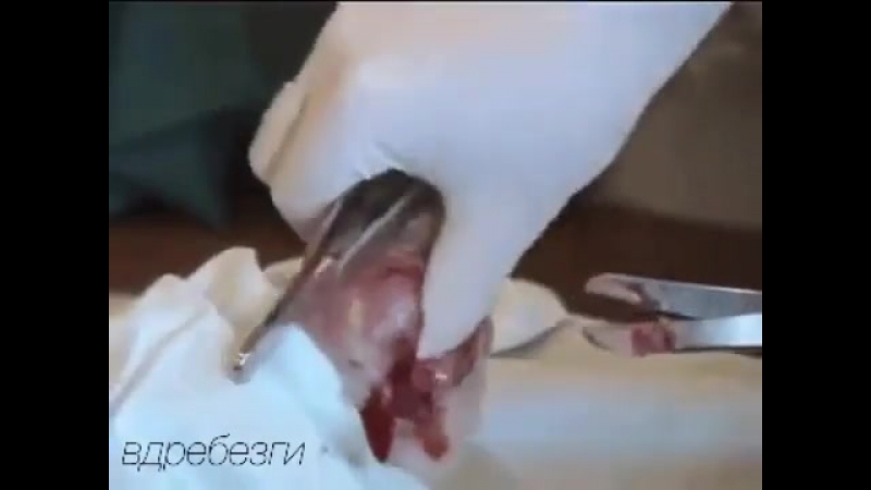 Удаление гноя из ноги