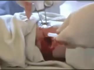 Устаноа дренажной трубки через контрапертуру