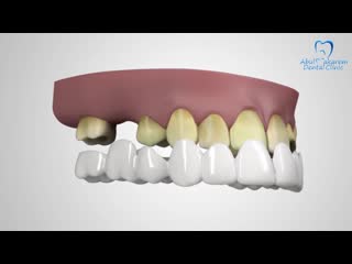 Snap on smile at abul makarem dental clinic [full hd 1080p]