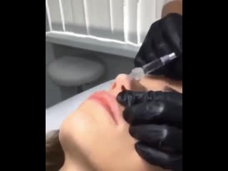 Увеличение губ с помощью гиалуроновой кислоты