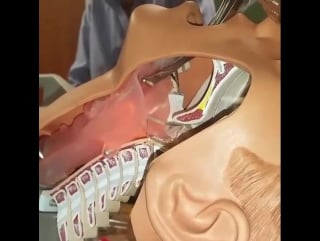 Это видео показывает как проходит интубация трахеи