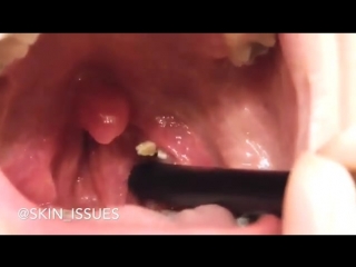 Камни в миндалинах (тонзиллолиты)