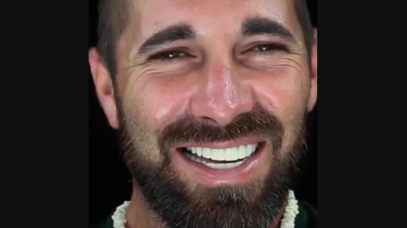 Виниры snap on smile