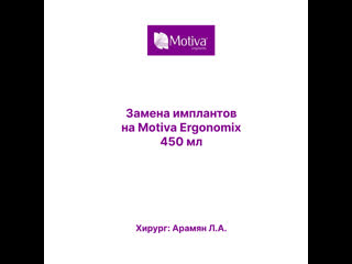 Результат вторичной маммопластики и замены имплантов на motiva ergonomix