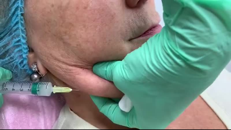 Инъекционная липосакция коррекция второго подбородка без отека, без боли и гематом 🔥🔥🔥