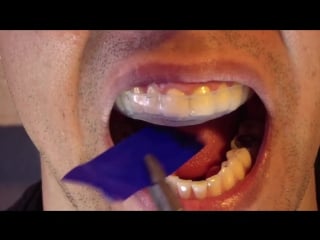 Bruxism splint part 6 insertion and occlusion