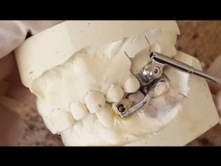 Orthodontic herbst appliance screw lesson ортодонтия гербст