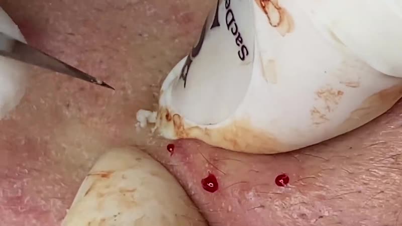 "тысяча выдавливаний", 8 сезон, серия 1 из 3