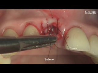 Immediate implantation with open membrane technique