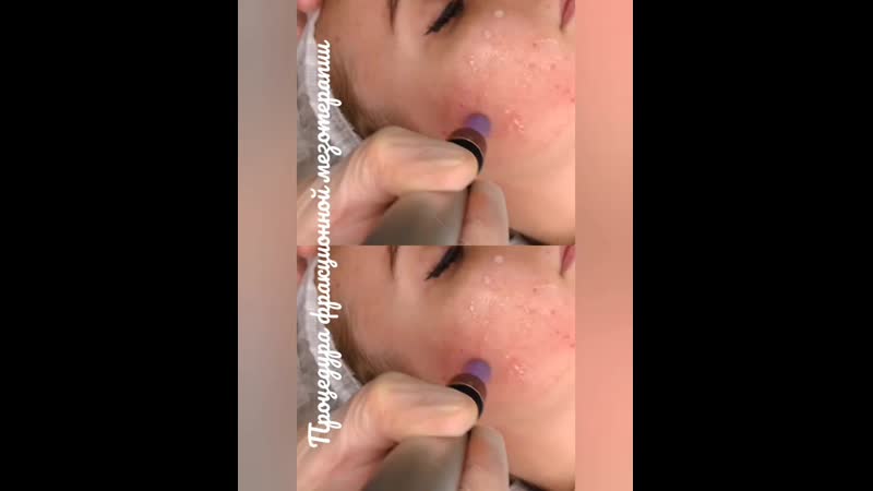 Фракционная мезотерапия