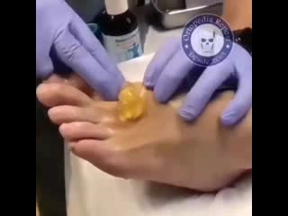 Удаление синовиальной кисты!