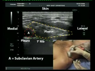 Ultrasound guided supraclavicular block (queen victoria hospital)