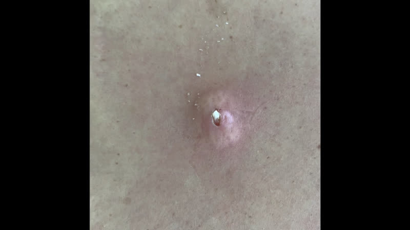 Лазерное удаление атеромы