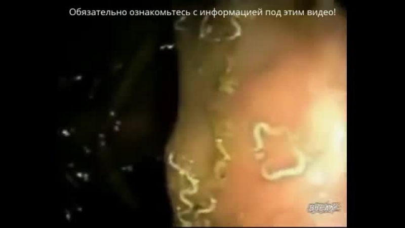 Глисты у человека (паразиты в организме) как избавиться от глистов у детей и взрослых? профилактика и лечение глистов(паразитов)