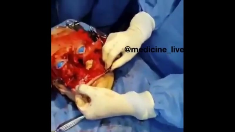 Трансплантация лица