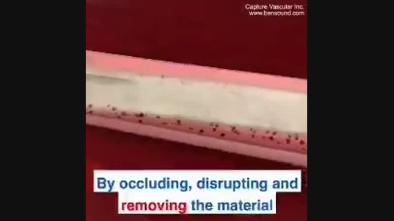 Удаление тромбов из артерии вакуумным методом врачи надеются, что эта революционная технология поможет спасти миллионы жизней