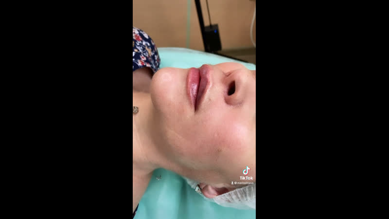Аугментация губ❤️