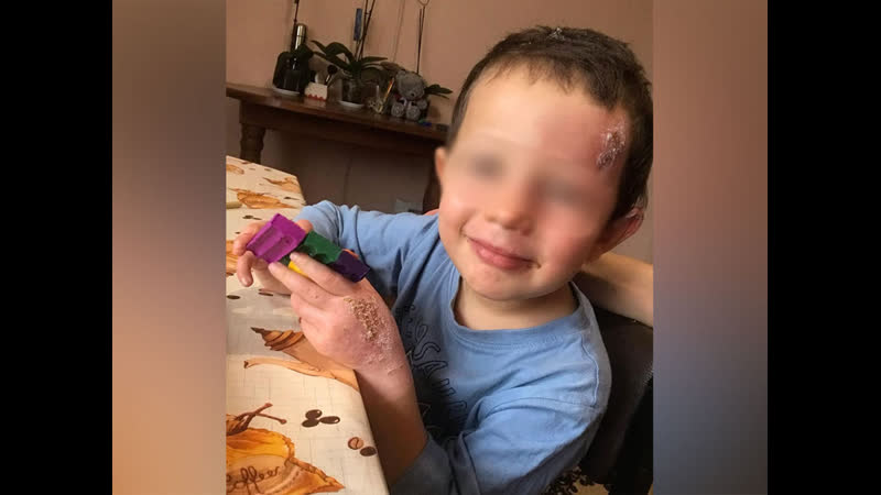 Из больницы выписали мальчика, которого отец чуть не сжёг в попытке отомстить жене за развод