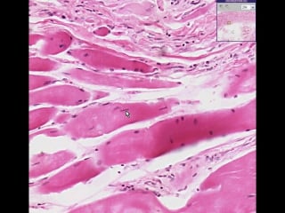 Skeletal muscle muscular dystrophy