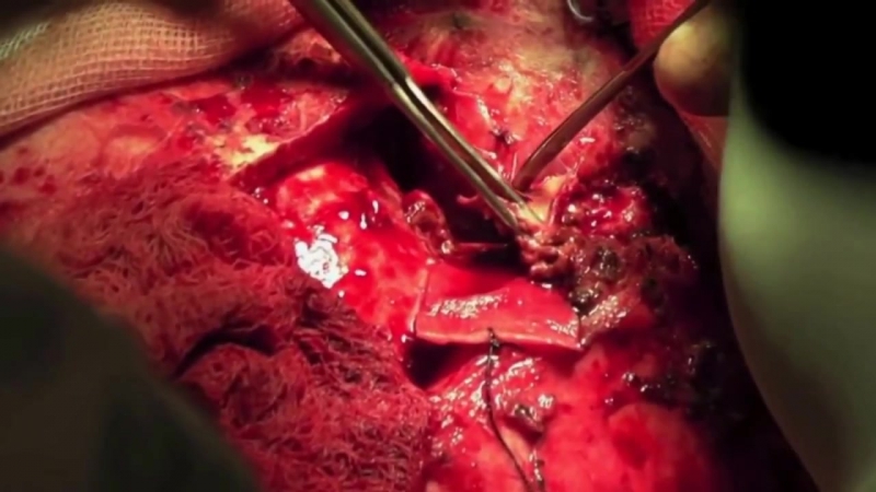 31 трепанация черепа удаление опухоли головного мозга