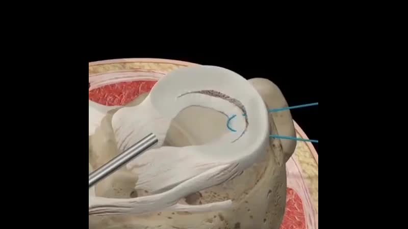 Продольный, или разрыв ручки ковша, возникает, когда мениск разорван по его окружности и его внутреннее поле смещено ⁣