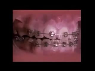Брекеты в действии