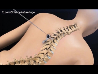 Fixing a curved spine with a minimally invasive scoliosis surgery