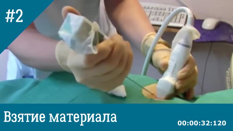 Трепан биопсия опухоли молочной железы под контролем узи