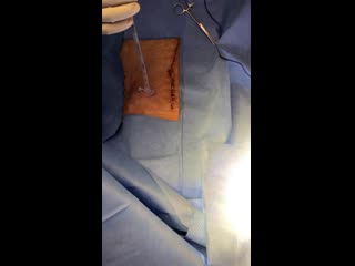 Gastrostomía endoscópica percutanea guiada por ultrasonido 3