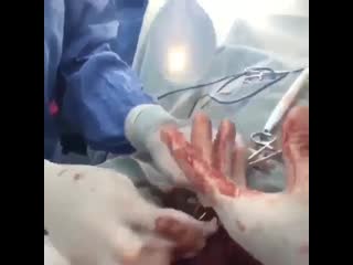 Протезирование яичка