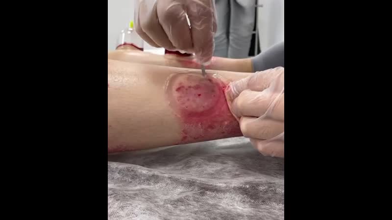 Хиджама при псориазе