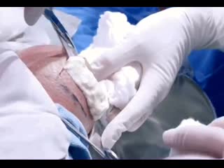 Киста коленного сустава